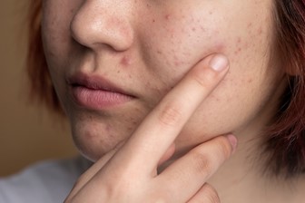 How to Get Rid of Acne Scars: The Most Effective Treatments Available