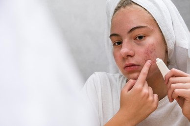 Understanding Acne scar: Skincare and Sun Protection